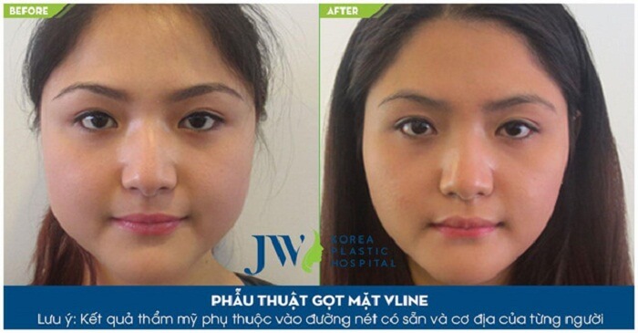 Gọt mặt V Line_12