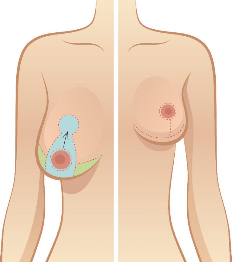 Nâng ngực chảy xệ sau sinh giá bao nhiêu?_2