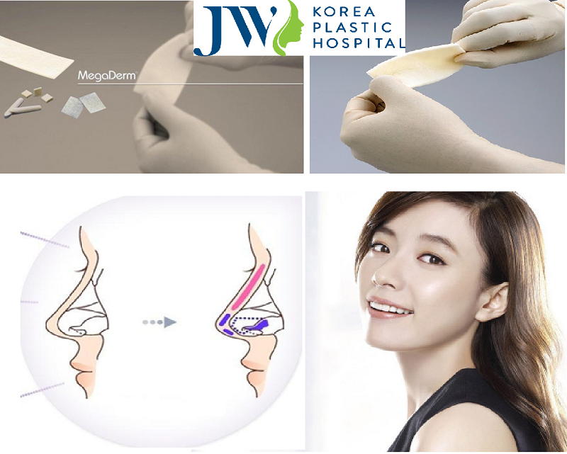 phẫu thuật nâng mũi s line megaderm có tốt không