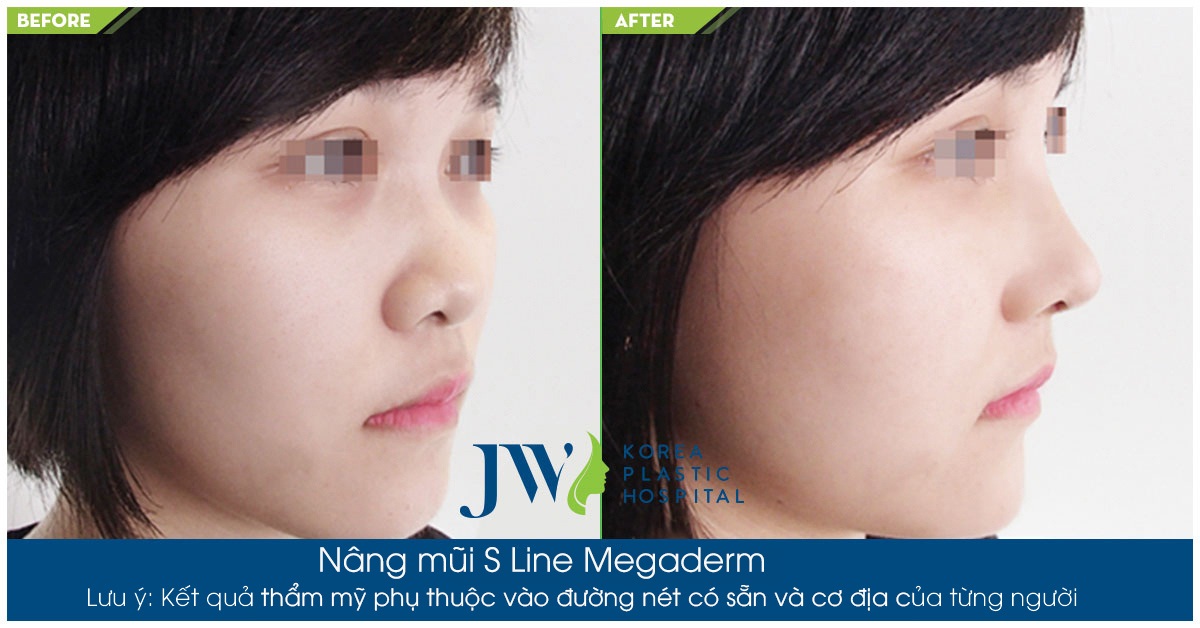 nâng mũi s line megaderm
