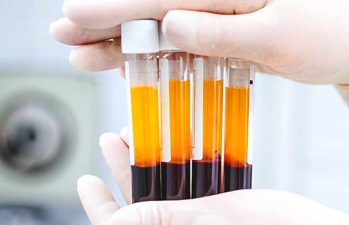 Phẫu thuật chỉnh hàm hô và những lưu ý không nên bỏ qua_5