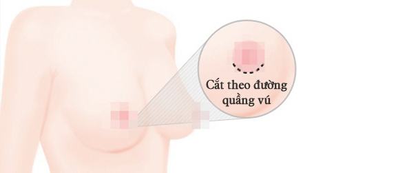 Nâng ngực chảy xệ sau sinh giá bao nhiêu?_1