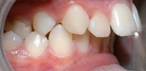 Chỉnh răng hô móm bằng cách nào Chỉnh răng hô móm bằng cách nào