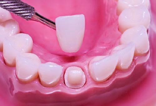 Chỉnh răng hô móm bằng cách nào Chỉnh răng hô móm bằng cách nào