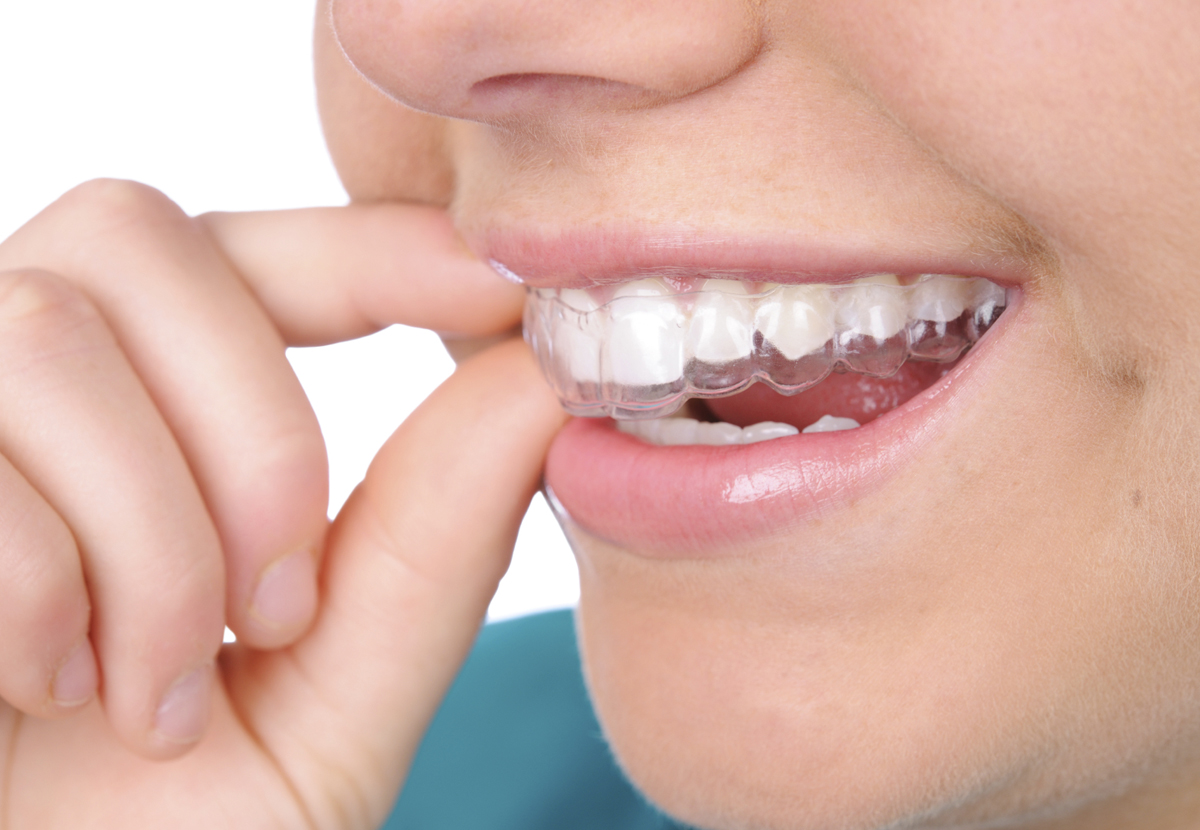 Chỉnh răng hô móm bằng cách nào Chỉnh răng hô móm bằng cách nào