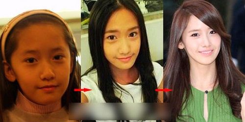 Yoona nâng mũi Yoona nâng mũi
