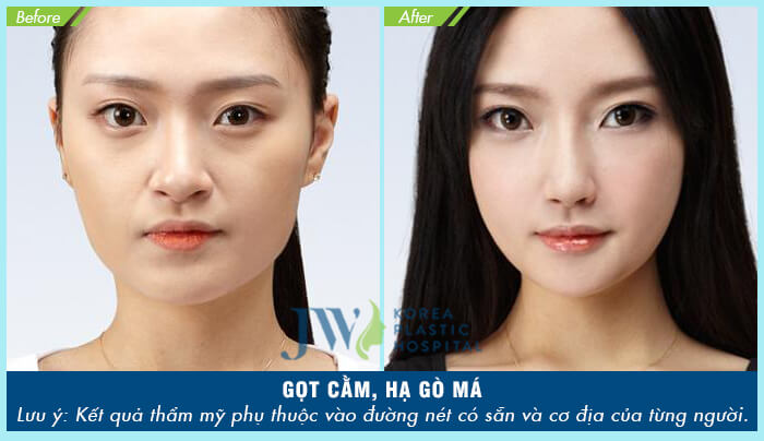 Phẫu thuật gọt cằm dài _4