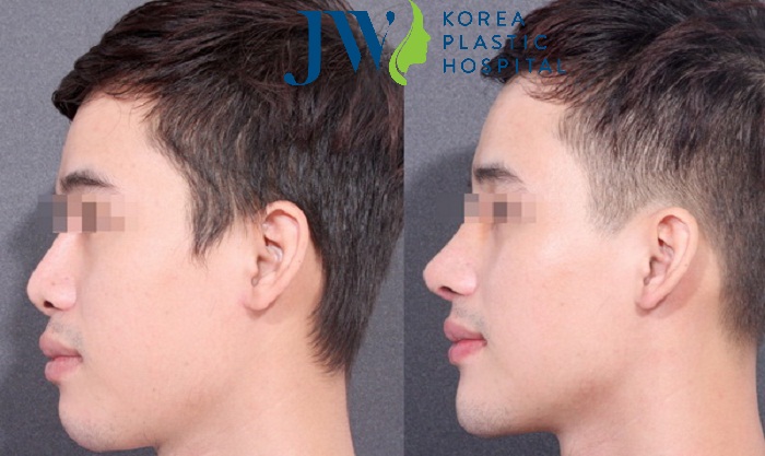 Độn cằm cho nam giới_4
