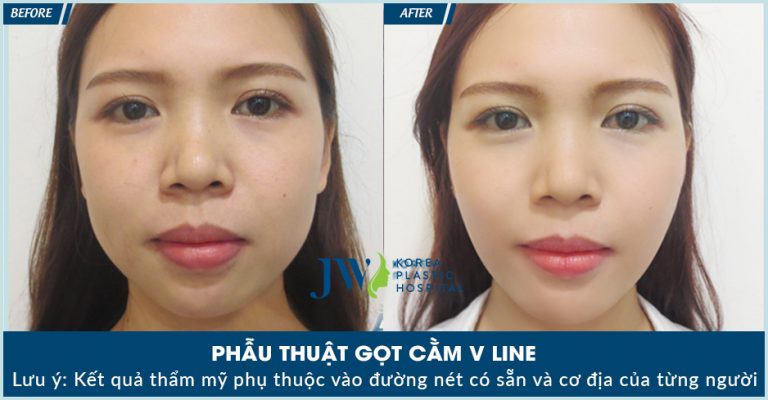 Phẫu thuật gọt cằm dài _6