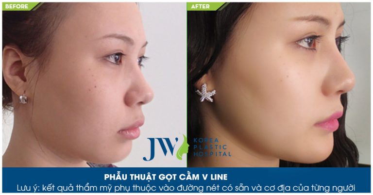Gọt cằm_8