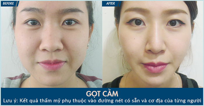 Phẫu thuật gọt cằm dài _5