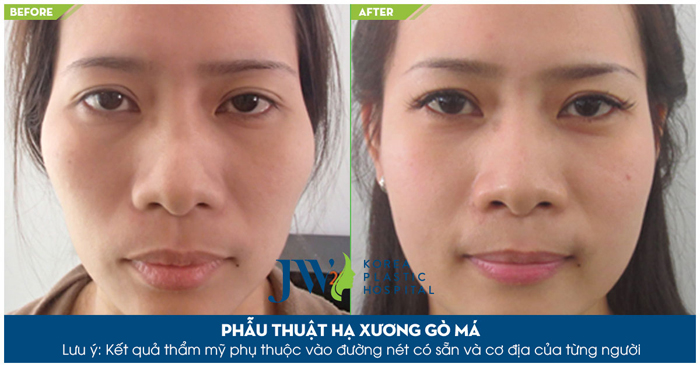 Phẫu thuật hạ gò má cao_7