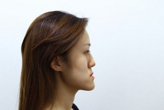 Cách chữa hàm móm