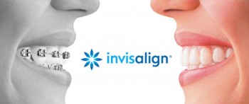 Người Việt đặc biệt quan tâm niềng răng và phẫu thuật hô, móm Người Việt đặc biệt quan tâm niềng răng và phẫu thuật hô, móm