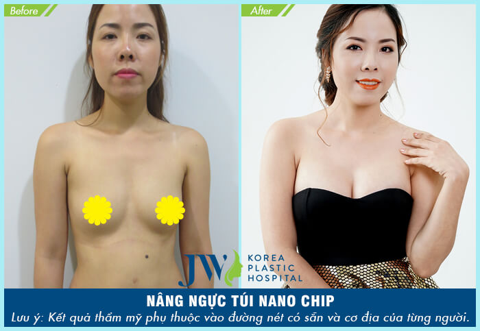 Phẫu thuật nâng ngực chảy xệ có đau không?_8