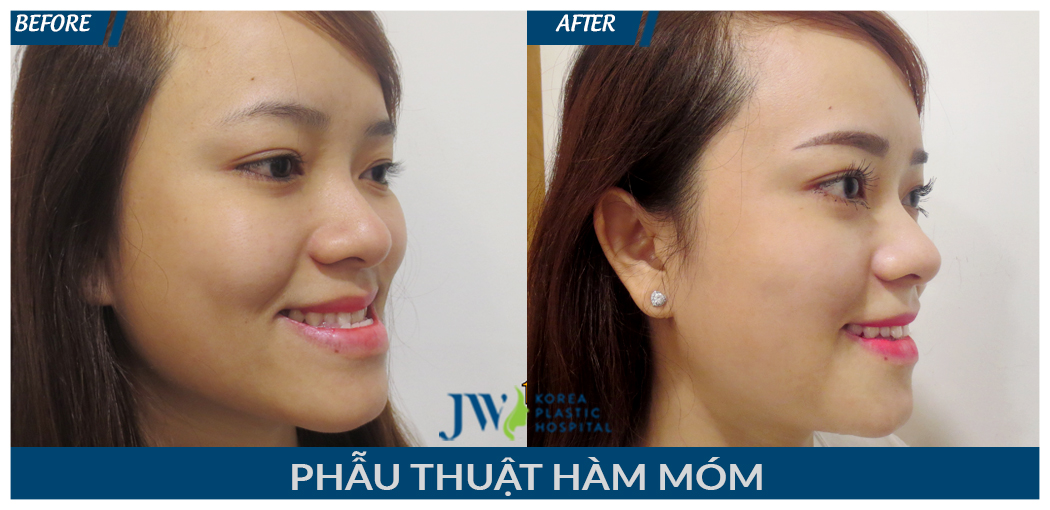 Phẫu thuật cắt xương chữa hàm móm
