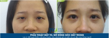 Ngẩn ngơ trước đôi mắt trong veo sau phẫu thuật mắt to