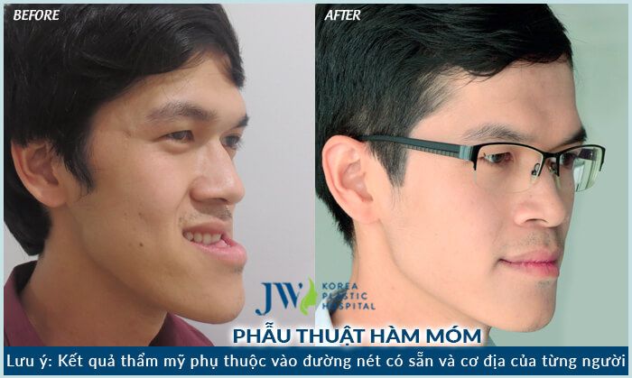 điều trị hàm hô móm không cần niềng răng - hình 2
