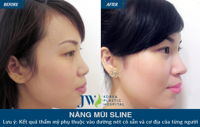 Trường hợp mũi ngắn, sóng mũi nâng hỏng bị bóng đỏ và không tự nhiên khiến gương mặt đơ. Sau khi khắc phục bằng nâng mũi S line, gương mặt hài hòa, cân đối hơn, chiếc mũi cao thon đáng mơ ước