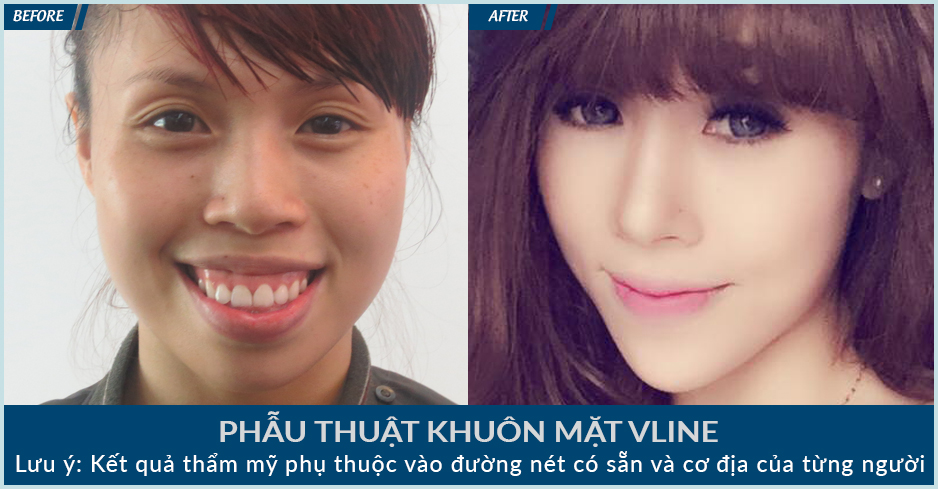 Gọt mặt V line_2