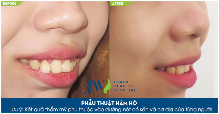 Phẫu thuật hô hàm dưới và hô hàm trên