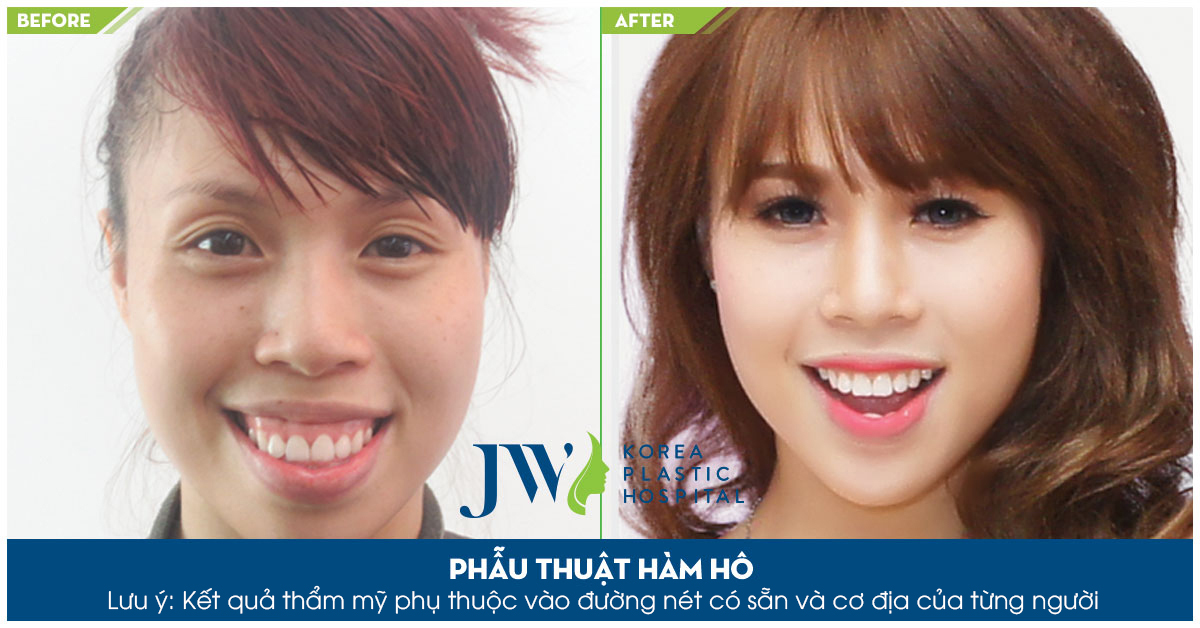 phẫu thuật chỉnh hàm hô giá rẻ