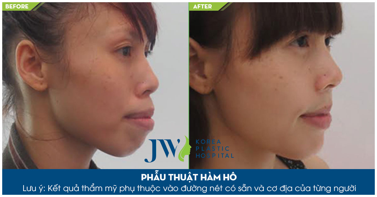 Phẫu thuật hàm hô ở đâu đẹp