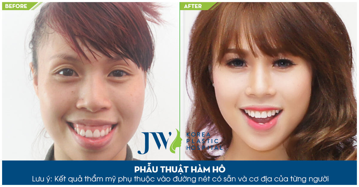 Phẫu thuật hô hàm dưới và hô hàm trên