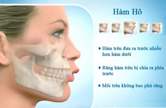 phẫu thuật chỉnh hàm hô giá rẻ