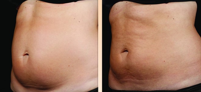 Giảm mỡ  Sculpsure giá bao nhiêu tiền