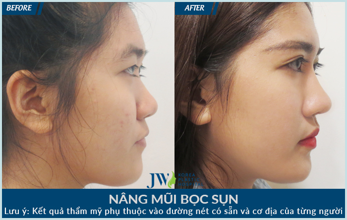 Nâng mũi Hàn Quốc sụn mềm ở đâu