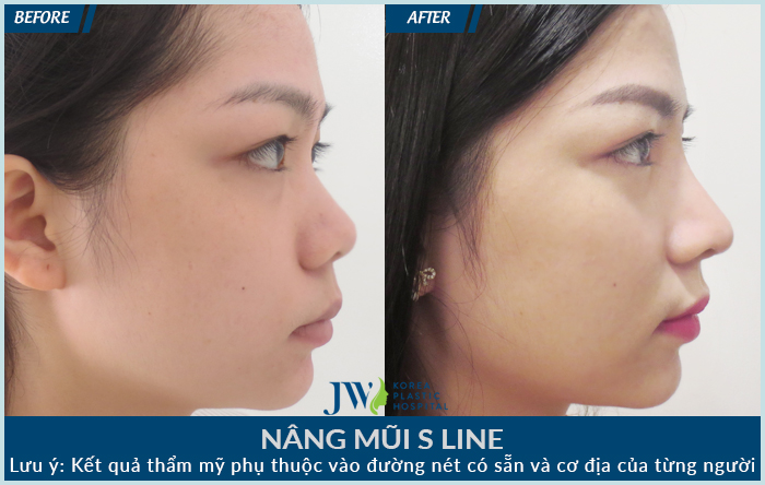 Nâng mũi ở Hàn Quốc giá bao nhiêu