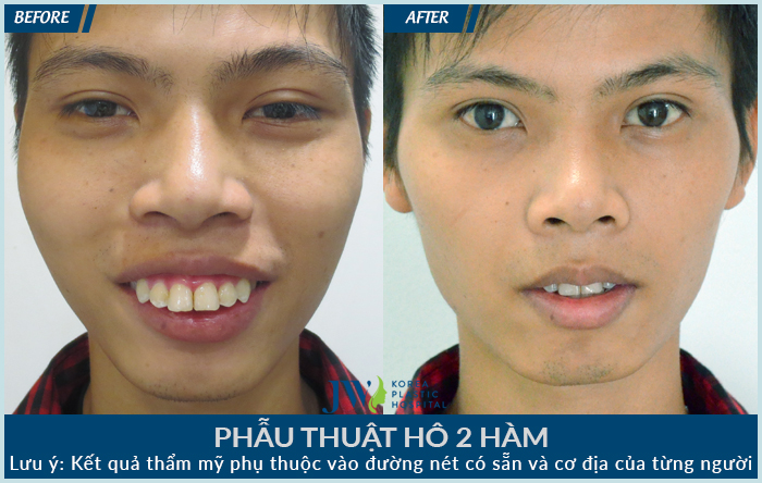 Phẫu thuật hàm hô sưng bao lâu