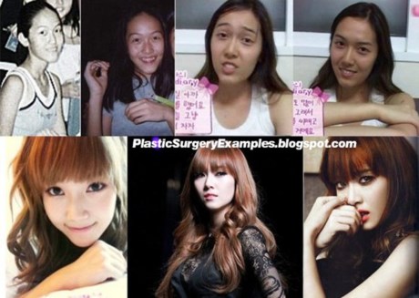 SNSD có phẫu thuật thẩm mỹ hay không