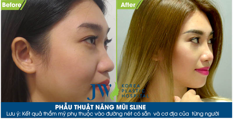 Nâng mũi Hàn Quốc an toàn