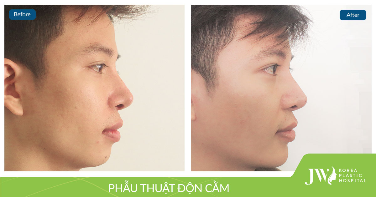 Độn cằm cho nam giới_2