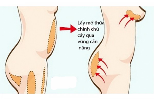 Nâng ngực tự nhiên không phẫu thuật Nâng ngực tự nhiên không phẫu thuật