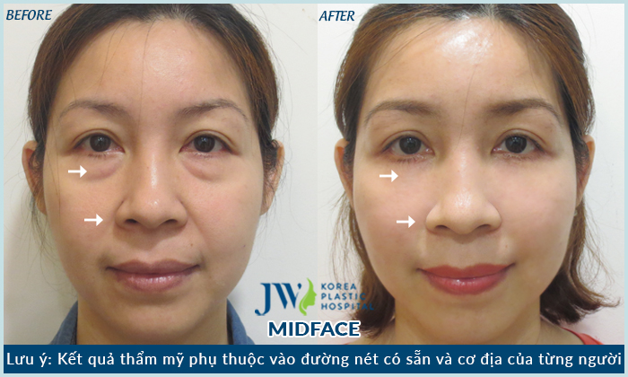 midface (1)