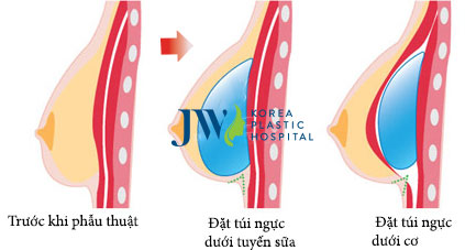 Thẩm mỹ vòng một Thẩm mỹ vòng một