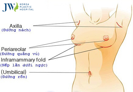 Nâng ngực sử dụng được bao lâu Nâng ngực sử dụng được bao lâu