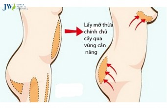 Nâng ngực sử dụng được bao lâu Nâng ngực sử dụng được bao lâu