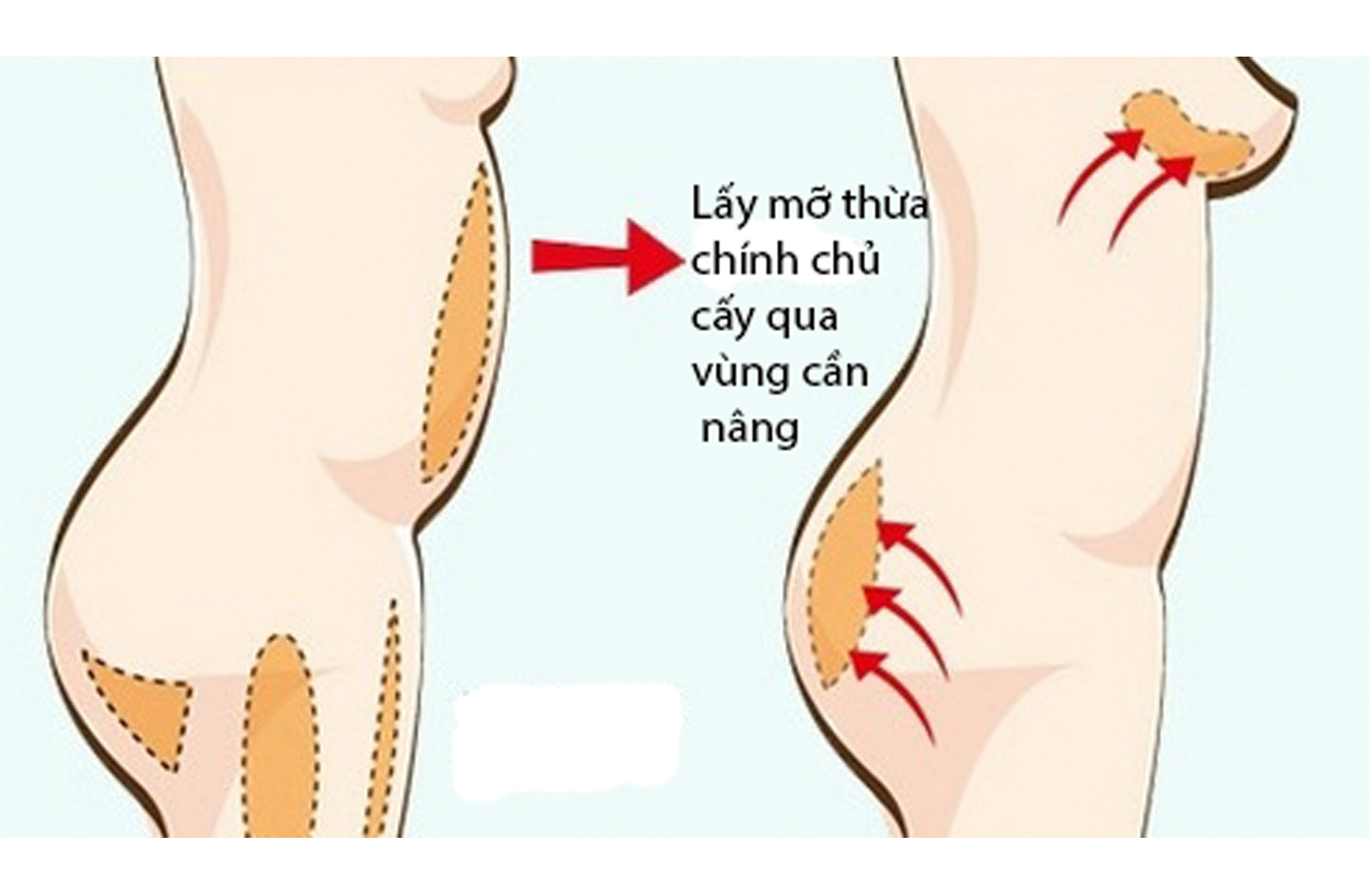Nâng ngực an toàn nhất hiện nay