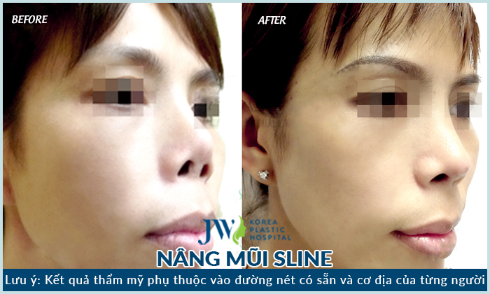 Mũi bị co rút, biến dạng đã được khắc phục nhờ nâng mũi S line tại JW Mũi bị co rút, biến dạng đã được khắc phục nhờ nâng mũi S line tại JW