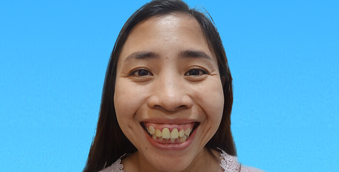 Từ bé chị Trà luôn mơ ước sẽ được cải thiện khiếm khuyết hàm mặt của mình