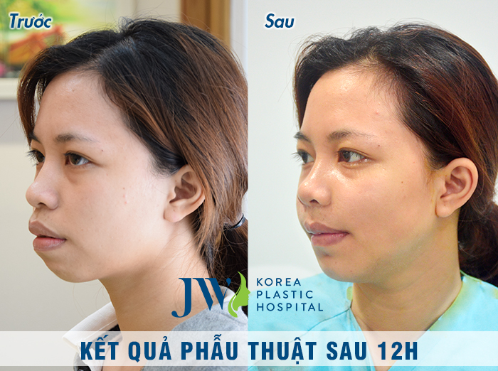 Hằng đã được điều trị phẫu thuật hàm hô miễn phí tại JW, kết quả thay đổi rõ rệt, khiến cô vui mừng khôn xiết. Đây là hình ảnh sau phẫu thuật 12 giờ của Hằng