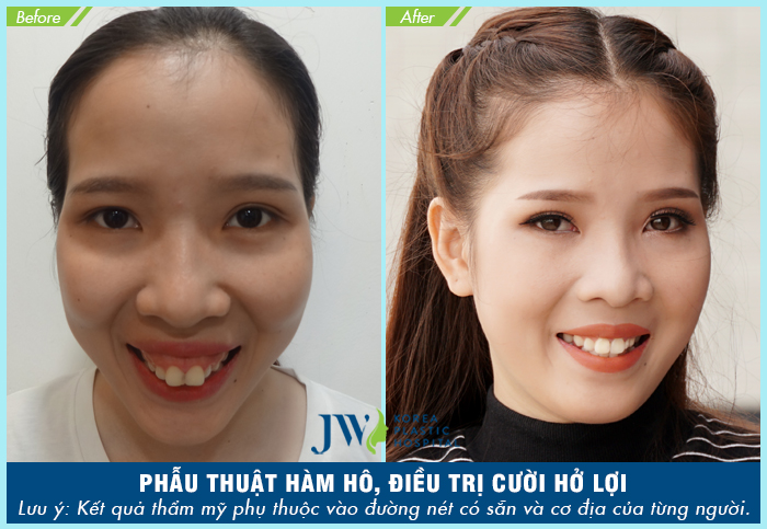 điều trị hàm hô móm không cần niềng răng - hình 1