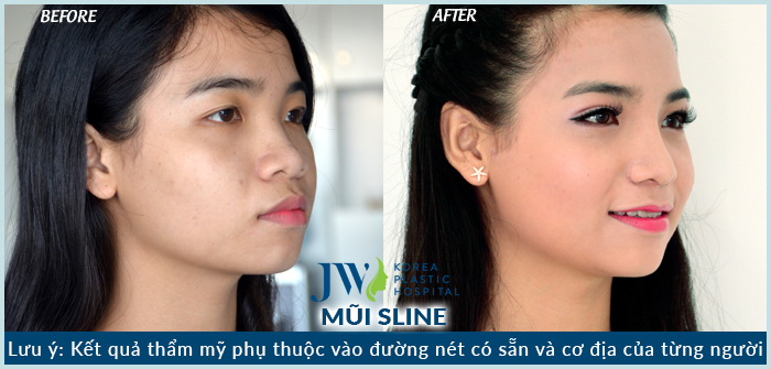 Nâng mũi S Line bao nhiêu tiền tại Bệnh viện Thẩm mỹ JW-4