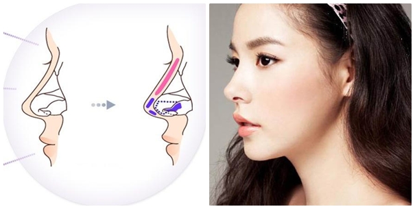 Nâng mũi S Line bao nhiêu tiền tại Bệnh viện Thẩm mỹ JW-3
