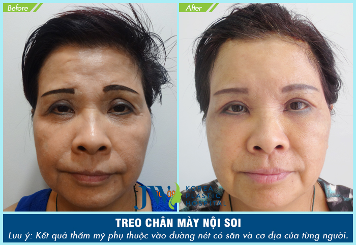 Nâng cung chân mày được bao lâu - Ảnh 6