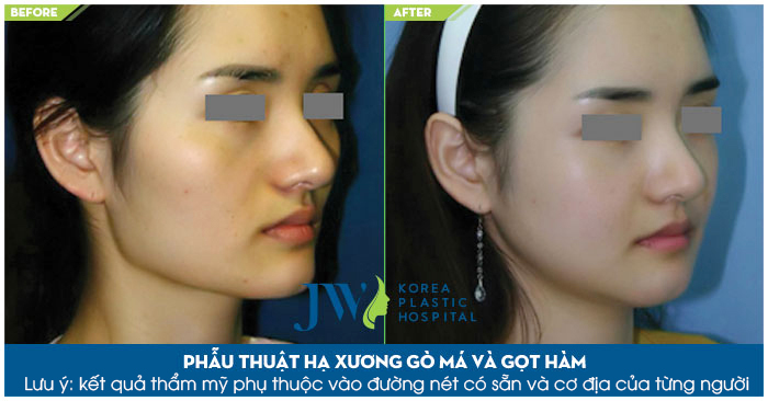 Ảnh khách hàng hạ gò má